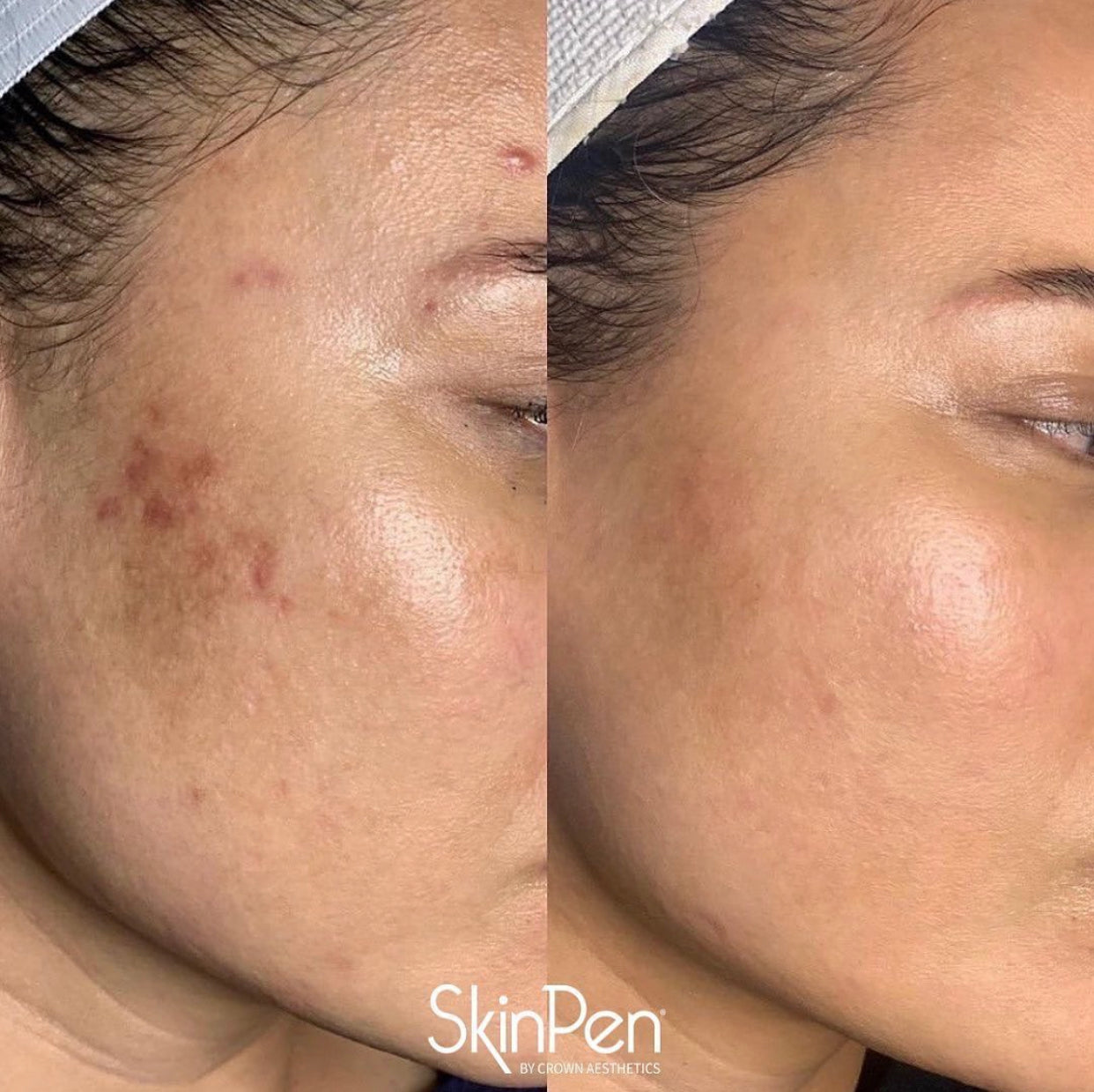 LIMITED EDITION - Exosome Microneedling