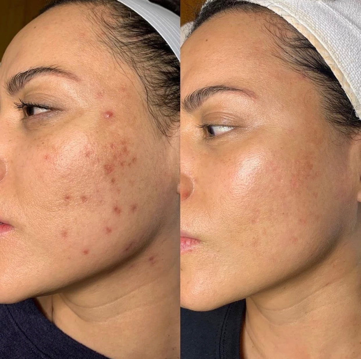 LIMITED EDITION - Exosome Microneedling