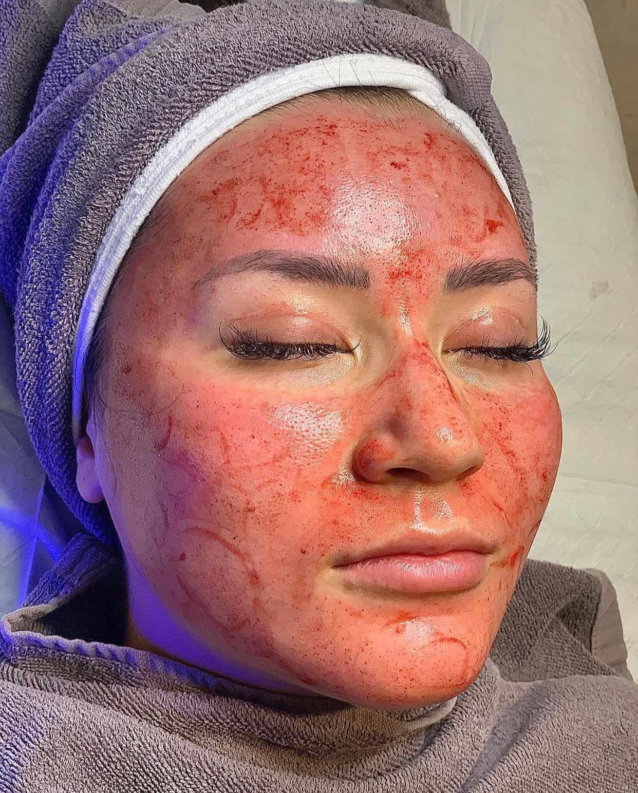 LIMITED EDITION - Exosome Microneedling