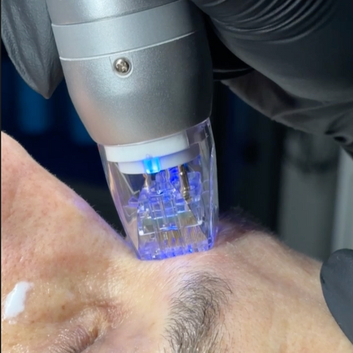 Buy 2, get 1 FREE Scarlet SRF Microneedling (SLC)