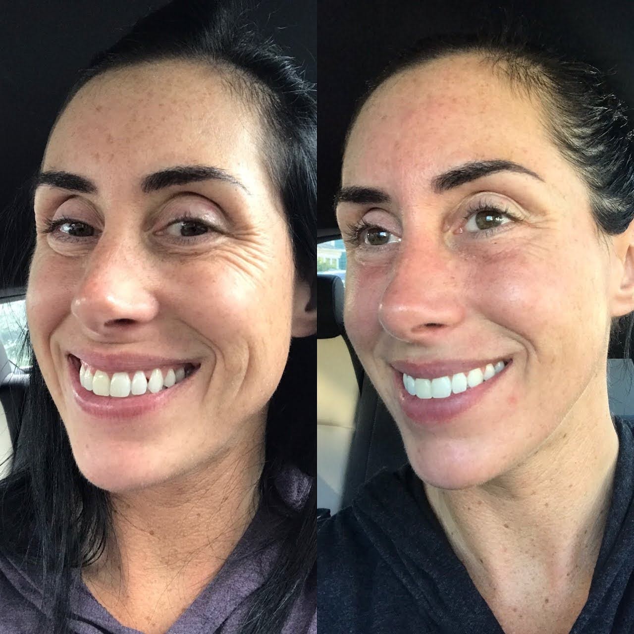 Agnes RF Microneedling - Eyes