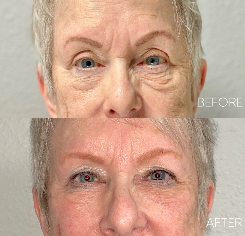 Agnes RF Microneedling - Eyes