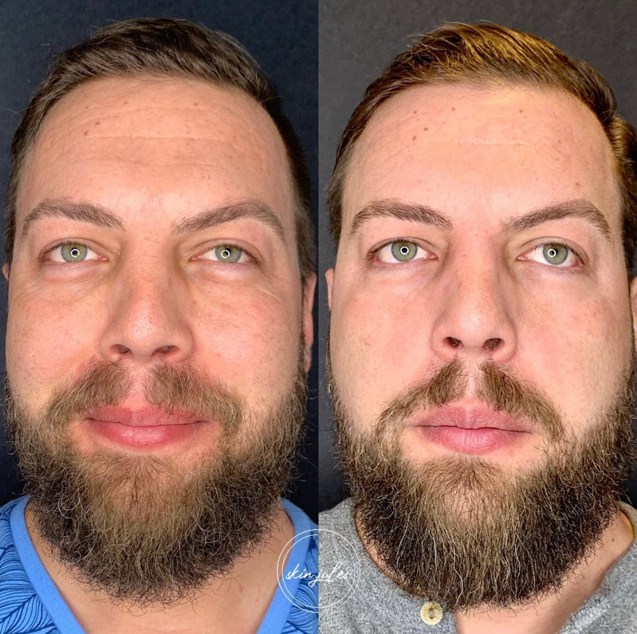 LIMITED EDITION - Exosome Microneedling