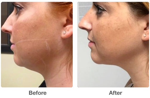 Agnes RF Microneedling Lower Face Haus of Aesthetics SLC